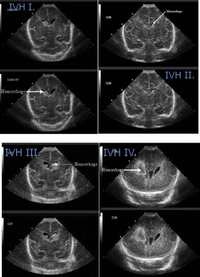 Figure 3.5.1.Cranial ultrasound images of different grades of IVH. White arrows show the heamorrhage at the pictures