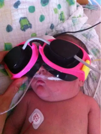Figure 5.1.2.3. The light emitting diode goggle is held in front of the eyes of the sleeping infant for binocular stimulation