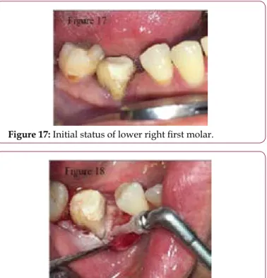 Figure 15: Initial status of lower right first molar. a)  PPD (mm): 5.5 b)  GR (mm): 2.3 c)  BoP(%): 66 d)  PI (%): 50 e)  CAL: 7.8 Case 4