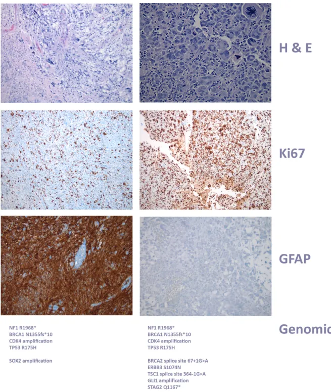 Figure 4: Histology of case 1, glioblastoma progression.  The original right temporal mass resected in 2011 showed glial neoplasm  with vascular proliferation, necrosis, mitosis, and numerous pleomorphic cells, including rare giant cells