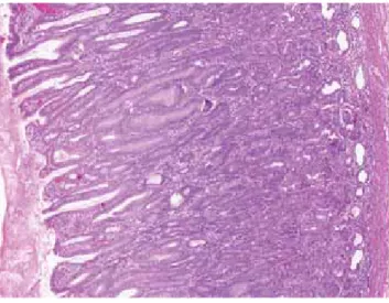 15. ábra Menetrier-kór: a megvastagodott redők mikroszkópos képe a  foveolák megnyúlását mutatja, ami hyperplasticus polipra  emlé-keztető képet nyújt