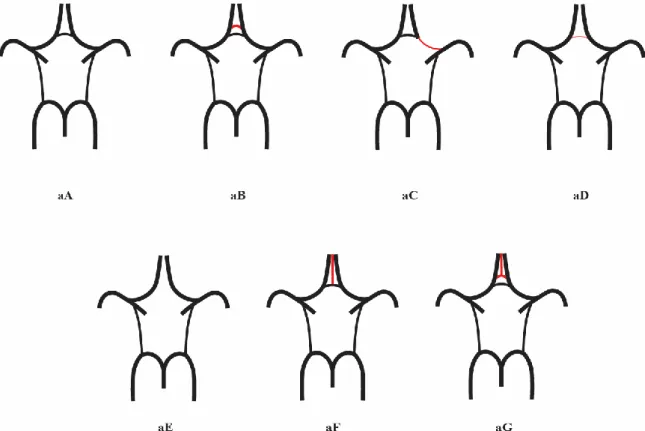 Figure 2. Variants of the anterior part of the CoW. aA: „Normal” variant with single,  non-hypoplastic ACoA and ACAs