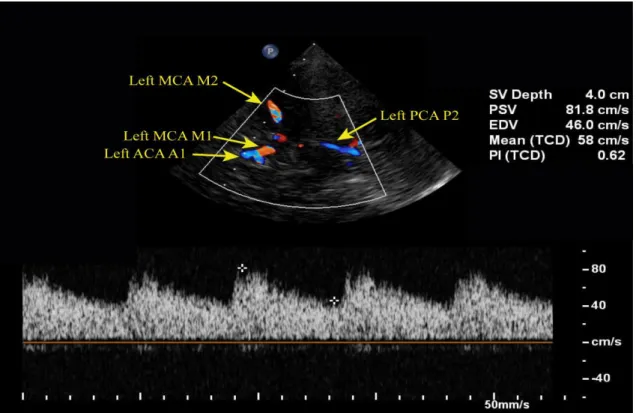 Figure 4. TCCS showing normal flow velocities in the left MCA. ACA: anterior cerebral  artery, EDV: end-diastolic velocity, MCA: middle cerebral artery, mean (TCD): mean 