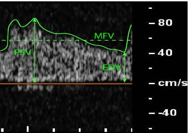 Figure 9. Illustration of measured TCD and TCCS parameters during one cardiac  cycle. EDV: end-diastolic velocity, MFV: mean flow velocity, PSV: peak systolic 