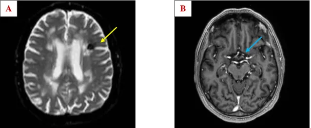 Figure 10. ADC map (A) of a 68-year-old male patient shows subacute ischemic  changes at the frontal horn of the left lateral ventricle (yellow arrow)