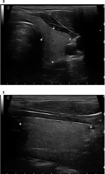 Figure 1. Measurement of the thyroid volume and isthmus using electronic  calipers at the time of scanning