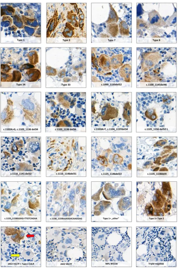 Figure  4.  Positive  staining  of  megakaryocytes  in  MPN  cases  with  eighteen  different  CALR  mutations using the CAL2 monoclonal antibody