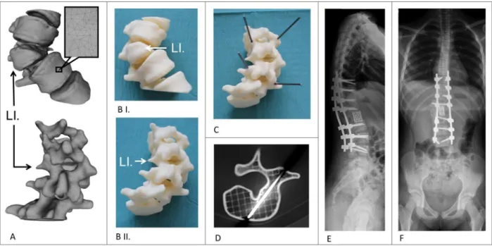 Fig. 9. Application of the FDM 3D printed model in the surgical planning process in congenital scoliosis
