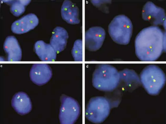 8. ábra Reprezentatív képek fúziós (a, b), valamint „break apart” próbát (c, d) alkalmazó FISH vizsgálat  eredményéről  EWSR1-transzlokáció  negatív  (a,  c)  és  pozitív  (b,  d)  tumorsejteken (Bridge és mtsai 2006)