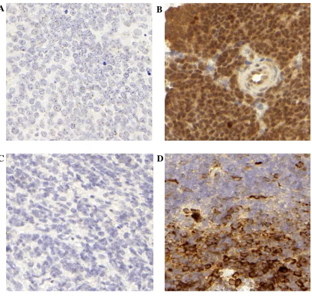 11. ábra: mTORC1 aktivitás kimutatása humán medulloblastoma szövetben 