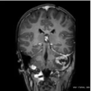 5. ábra MRI T1+C coronális 