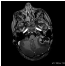 7. ábra Koponya MRI T1+C  axialis sorozat, ugyanaz a bal  oldali cerebellaris tályog 