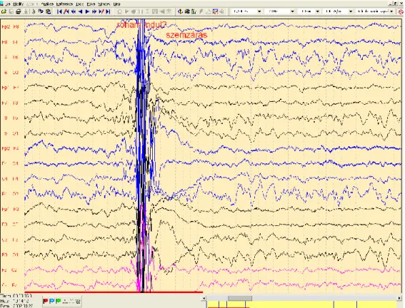 8. ábra Dialeptikus roham eleje, mely ülő helyzetből hirtelen hátradőléssel kezdődik,  ennek mozgásos műterméke látható az EEG-n.