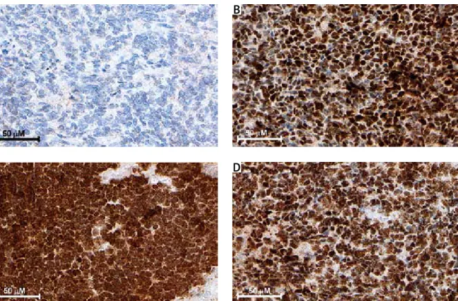 Fig. 1. Representative immunohistochemical staining of DNMTs in medulloblastoma. A) Negative staining  of DNMT3A