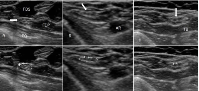 Figure 4. Normal ultrasound images of three different nerves. On the lower images, the  tracing used to measure the cross sectional area is shown