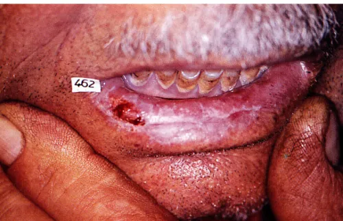 3. ábra. Cheilitis sorlaris klinikai képe. Az alsó ajak jobb szélén  kifekélyesedő, tömött tapintatú,  fájdalmatlan elváltozás látható
