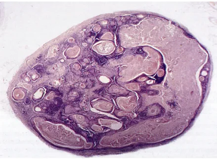 5. ábra. Nyaki nyirokcsomó karcinóma áttéttel; HE 10X. A nyirokcsomóban elszarusodást  mutató sejtfészkek szorítják ki a nyirokszövetet