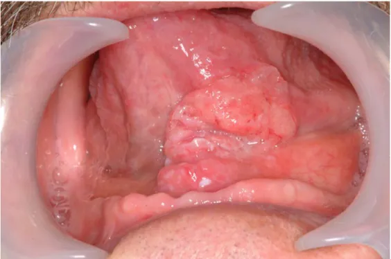 9. ábra. A nyelvgyök burjánzó rosszindulatú tumora. Dr. Németh Zsolt anyagából. 