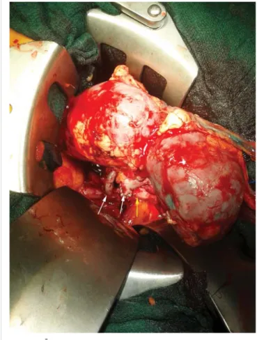 Fig. 2. Intraoperative picture of the graft and the vascular anas- anas-tomoses. The yellow arrow represents the venal, the two  white arrows show the arterial anastomoses