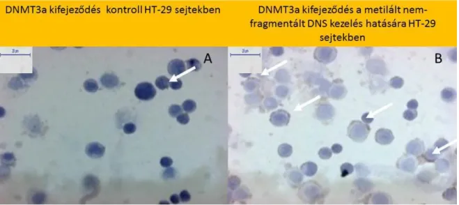 14. ábra: Gyenge citoplazmatikus DNMT3a festődés a PBS kezelt kontroll HT-29  sejtekben (14A ábra) és fokozott DNMT3a kifejeződés (14B ábra) az MnF HT-29 DNS  kezelés hatására