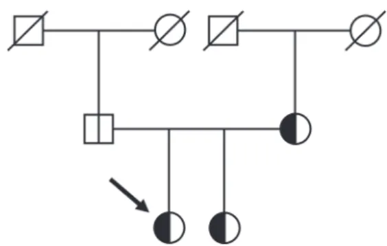 Figure 2 Pedigree of the examined family. Arrow indicates the  index patient. The vertical line in the symbols (circle: female,  square: male) denotes molecular genetic testing for the 32-kb  FBN1 deletion: white halves represent normal alleles and black  