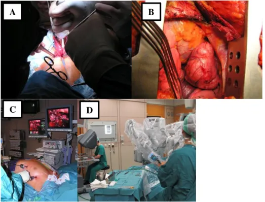 Figure 8: Surgical approach. Open surgery: through (A) cervical incision for basic thymectomy