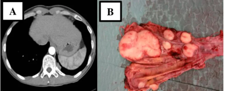 Figure 11: Pleural metastases of WHO type B2 thymoma. Representative CT scan section  of the regional  recurrence (A) with part of the operative specimen of total pleurectomy showing several pleural implants  (B)