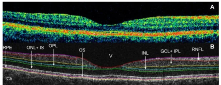 Figure 1: Macular image segmentation using the custom-built software  (OCTRIMA). (A) The image of a healthy macula scanned by STRATUS OCT