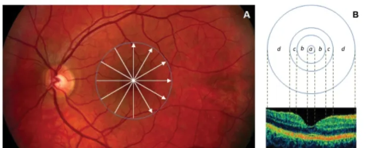 Figure 2: Custom-built method showing macular sectors. A) Fundus  image of a healthy eye showing the STRATUS OCT’s radial lines protocol