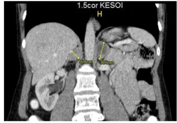 1. ábra Kontrasztos CT-n jobb oldali mellékvesében 16 mm átmérőjű,  a  bal mellékvesében 30 mm nagyságú, inhomogén  kontraszt-anyag-halmozást mutató térfoglaló képlet