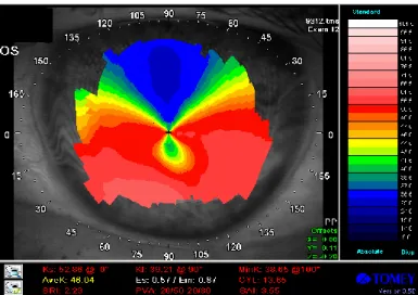 Figure 13. Corneal topography of a patient with PMD. The classical “butterfly” appearance  can be clearly seen on the axial map (from our own database)