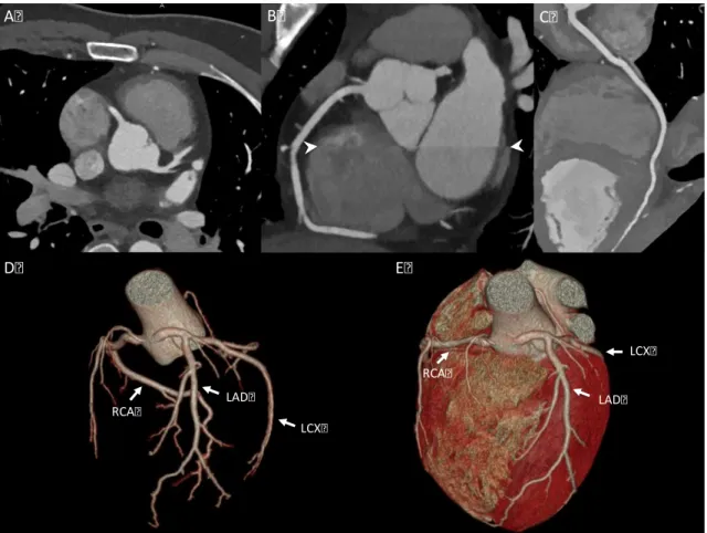 Figure  2.  CTA  images  and  volume-rendered  images  of  the  coronary  arteries  and  the  heart (own material)  