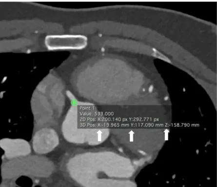 Figure 10. Axial CTA image of the heart with the origin of the RCA (own material)  X, Y and Z (white arrows) indicate the coordinates of the RCA origin and are used for  the calculation of the coronary artery velocity  