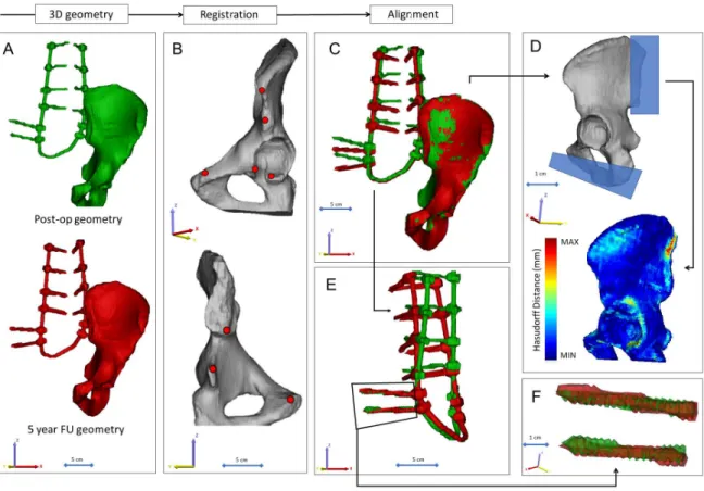 Figure 10.   Postop CT scan-based geometry definition and alignment. A Thresholding  based segmentation was performed on the postop CT scan in order to define the left iliac  bone and the implant construct