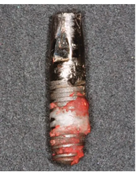 Fig. 3: Bone loss during trephan drill