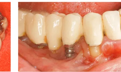 Fig. 6: Peri-implantitisFig. 5: Removed implant with prosthesis by peri-implantitis 