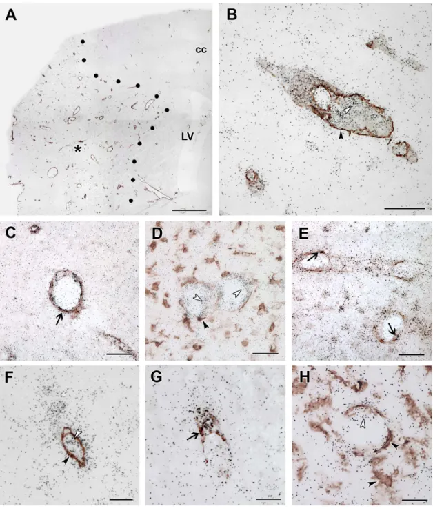 Figure 8. TGF-b RIII and ALK1 are induced in endothelial cells within the lesion. Double labeling of TGF-b RIII and ALK1 mRNA and immunoreactivity of the microglial marker Iba1, the endothelial marker vWF, and the marker of smooth muscle cells of vessels, 