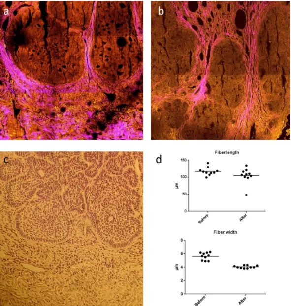 Figure  10:  (a-b)  Two-photon  emission  fluorescence  and  second  harmonic  generation  microscopy  (TPEFM  and  SHG,  respectively)  images  from  the  same  micronodular  basal  cell  carcinoma  lesion