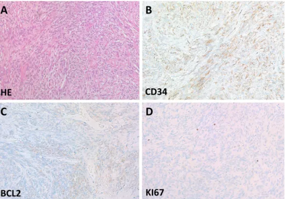 Figure 1.  Histological features of solitary fibrous tumors. (A) The hematoxylin-eosin staining demonstrates  relatively uniform tumor cells intimately intertwined between fibers
