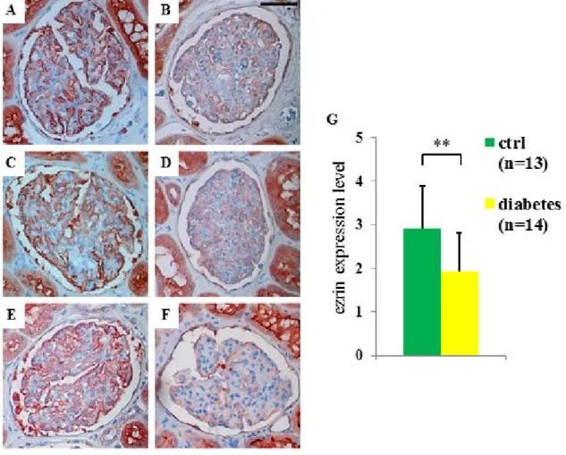 Figure 10: Immunoperoxidase staining for ezrin in glomeruli of controls (A, C, and E) and patients  with diabetes (B, D, and F)