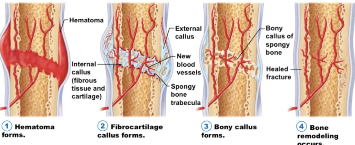 Figure 6.  The stages of fracture repair.  (1) Hematoma formation: following injury, fracture  disrupts bony blood supply leading to hematoma formation in and around the bony defect; (2)  Fibrocartilage  (soft)  callus  formation:  fracture  hematoma  is  