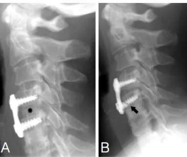 Figure 7.  Cancellous bone allograft resorption with hardware loosening and failure in a  46-year  old  woman