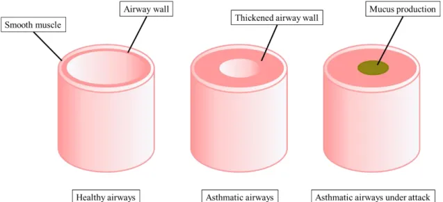 Figure 1. Schematic diagram of healthy and asthmatic airways. 