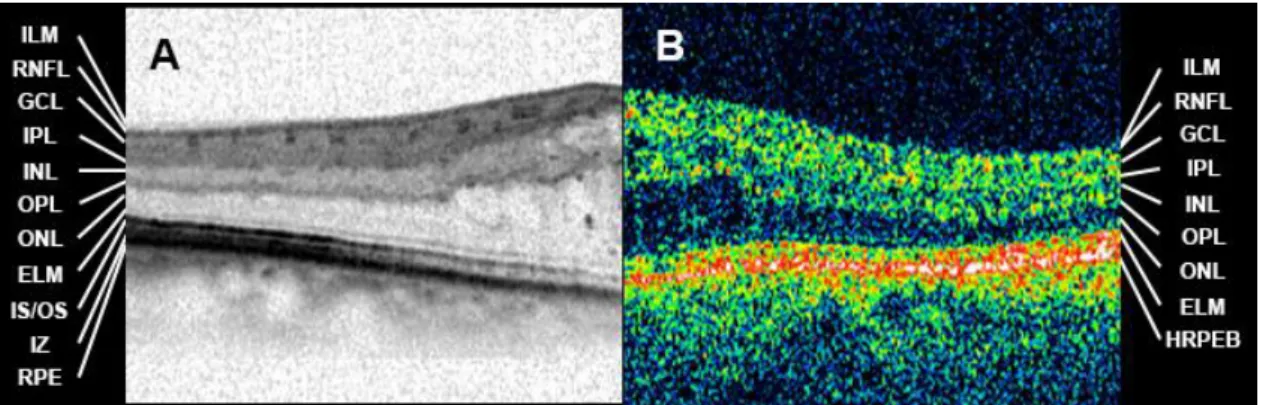 Figure  6.:  Schematic  drawing  of  a  time  domain  optical  coherence  tomography.  (TD- (TD-OCT) The reference mirror moves back to forth at every scan captured