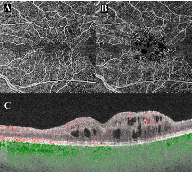 Figure 10.: OCT angiography of a patient with central retinal vein occlusion captured  with an SS-OCTA system