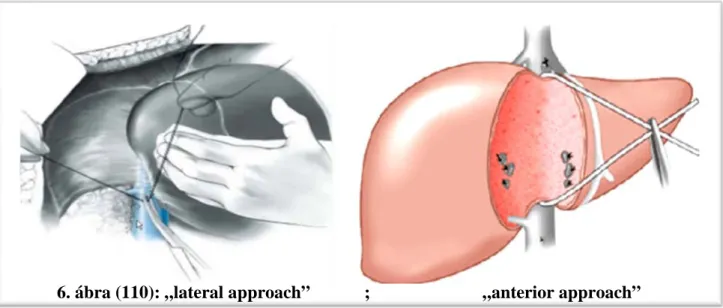 6. ábra (110): „lateral approach”            ;                         „anterior approach” 