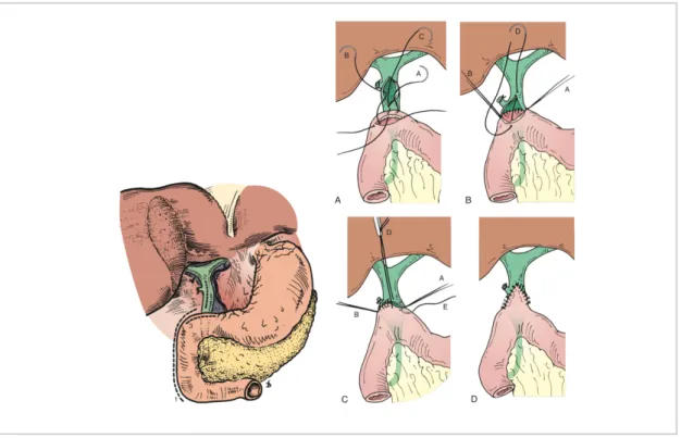 12. Ábra. Choledocho-duodenostomia sematikus ábrája. Jelölés nélüli képen a mobilizációt követő incisios  nyílások