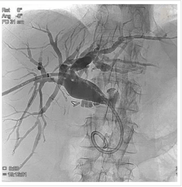 19. Ábra. Cholangiographia korábban behelyezett transhepaticus drainen keresztül. (saját anyagunkból,  SE I