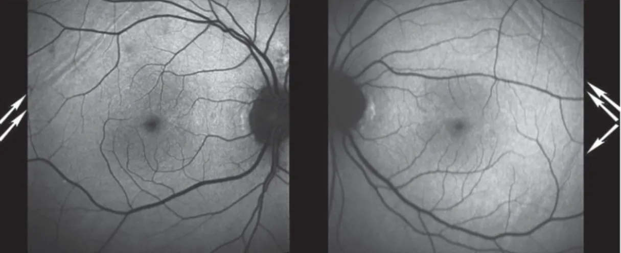 4. ábra Autoﬂ uoreszcencia. A choroidearedők a jobb szemen temporalisan a felső érárkádon, míg a bal szemen temporalisan a felső és az alsó érárkádon át- át-haladó világos és sötét vonalak formájában láthatók