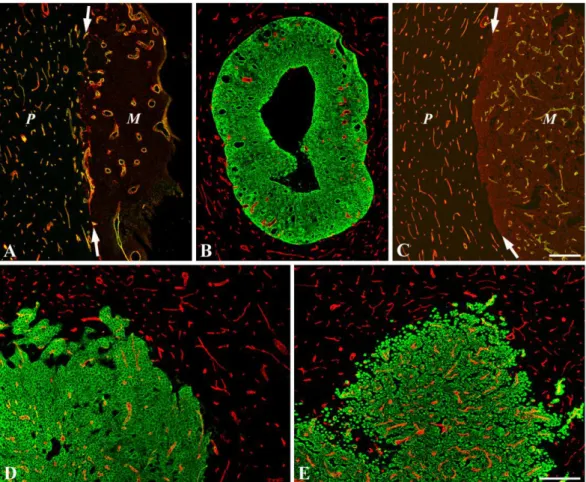 12. ábra: A különböző tumorok növekedési mintázatai fluoreszcens jelöléssel. (A) A  C38  metasztázisban  (M,  a  kép  jobb  oldalán)  az  endotélsejtek  CD31  (zöld)  és  az  erek  bazális  membránjában  megtalálható  laminin  (piros)  jelölése  kevés  dil